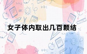 女子体内取出几百颗结石如鱼子酱 这也太吓人了吧！！