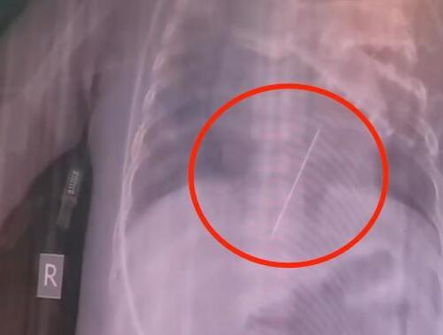 女婴心脏扎进一根4厘米绣花针  背后真相实在令人感到惊愕