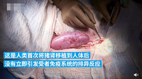 猪肾移植人体后成功撑过1个月：已正常工作32天 试验还将继续
