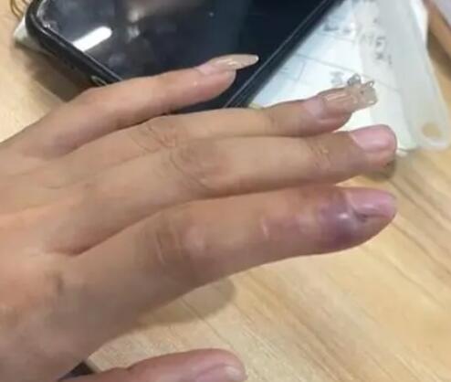 女子拔倒刺致骨髓炎要刮骨手术 内幕曝光简直太意外了