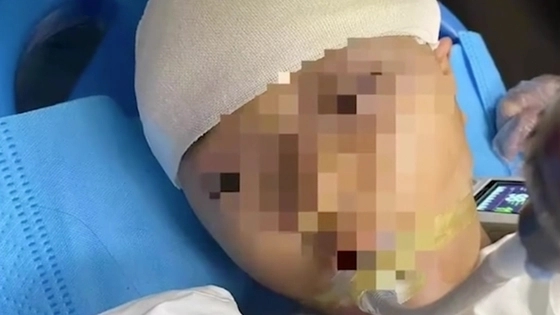 被老师打破头骨女孩仍在ICU抢救 背后真相令人感到震惊